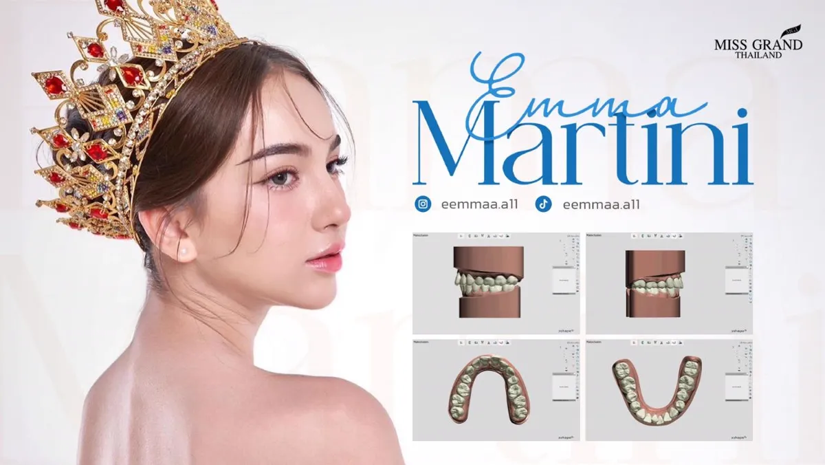 เคสจัดฟันใส Emma Martini Miss Grand Thailand พร้อมภาพสแกนฟัน 3 มิติ